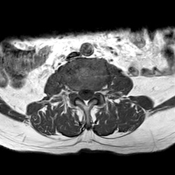 MRI_eeAX_T1W_Lumbal_902