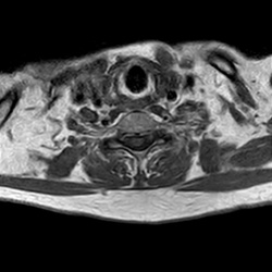 MRI_eeAX_T1W_Thoracal_802