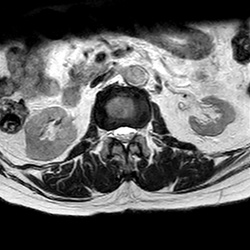 MRI_eeAX_T2W_Lumbal_1002