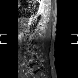 MRI_MobiView_Sag_STIR_TSE_503